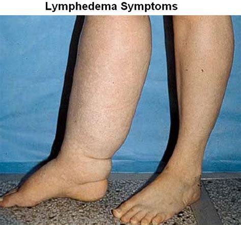 Lymphedema: Causes, Symptoms, Treatment And Prevention | Health And Beauty