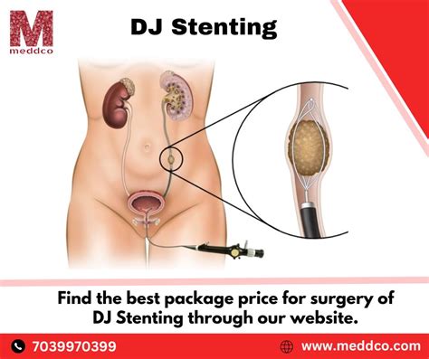 What is the purpose to clamp or attach a DJ STENT?