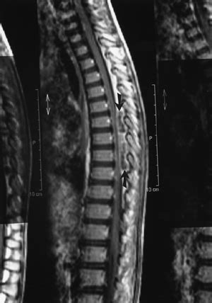 Spinal Epidural Abscess