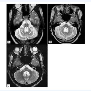 MRI T2W Axial MRI at mid-pontine level of Case 1 (A), Case 2 (B) and... | Download Scientific ...