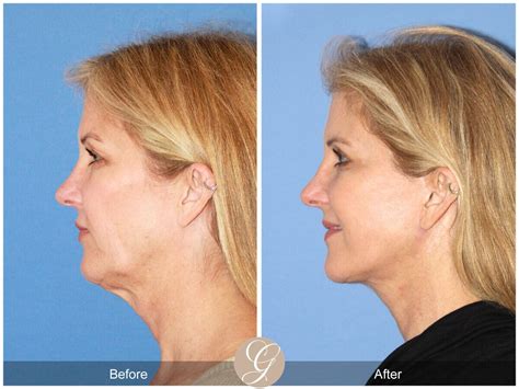 Neck Lift Before & After Photos Patient 103 | Dr Kevin Sadati