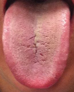 Tongue cracks - what do they say about your health? | Tongue health ...