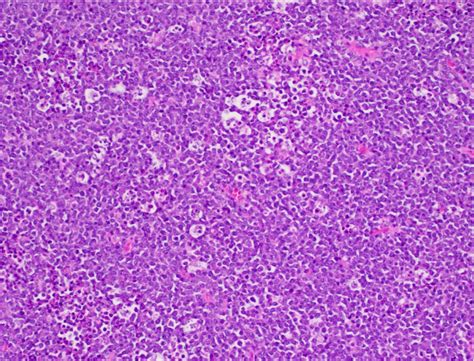 Pathology Outlines - Burkitt lymphoma