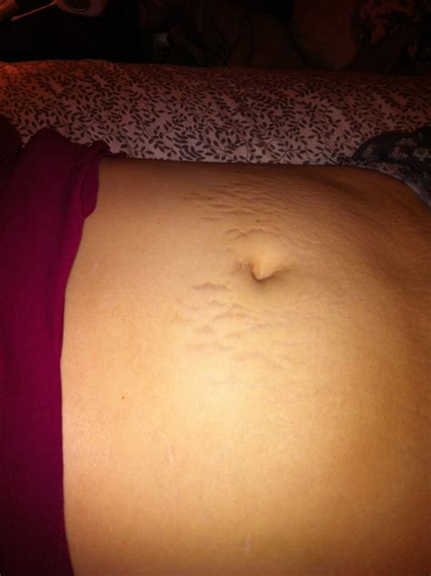 Mederma Stretch Marks Therapy - Modern Day Moms