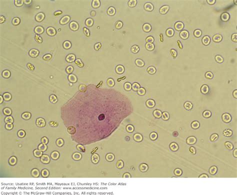 Urinary Sediment | Basicmedical Key