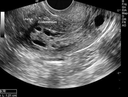 Uterine Cancer Ultrasound Images