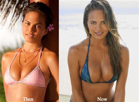 Chrissy Teigen Plastic Surgery Before and After Photos