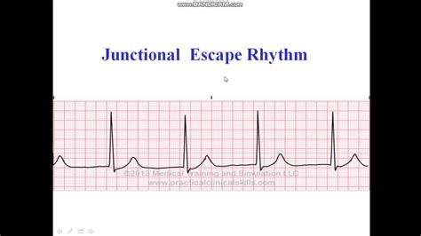 Junctional Escape Rhythm - YouTube