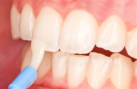 Fluoride Varnish as Effective as Sealants in Preventing Decay - Dentistry Today