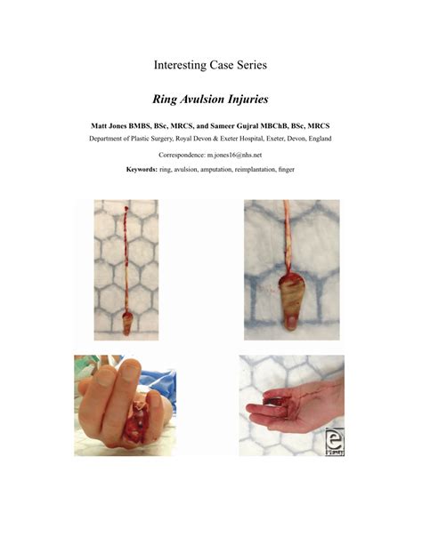 (PDF) Ring Avulsion Injuries