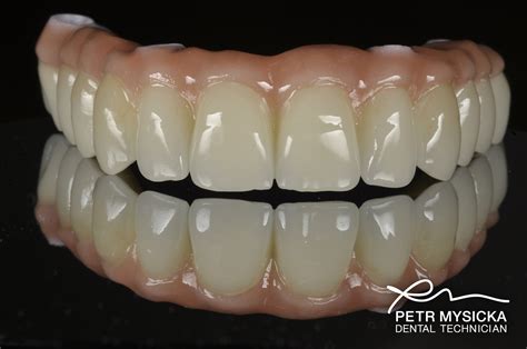 Zirconia All on 4 Bridge - Brighton Implant Clinic : Dental Implants