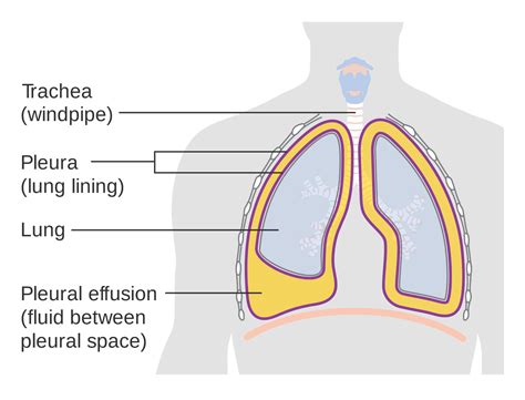 Derrame pleural: clasificaciones, clínica y exámenes. - AnSRo