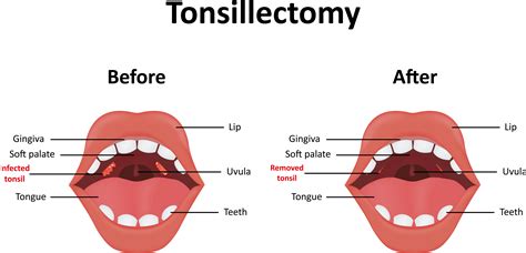 How To Get Rid Of Tonsil Stones - Creativeconversation4
