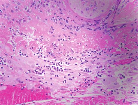 Chronic deciduitis, isolated to the decidua basalis. The decidua shows... | Download Scientific ...