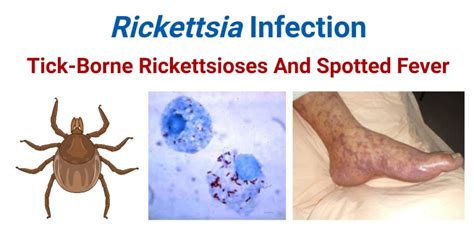 Rickettsia Prowazekii Under A Microscope