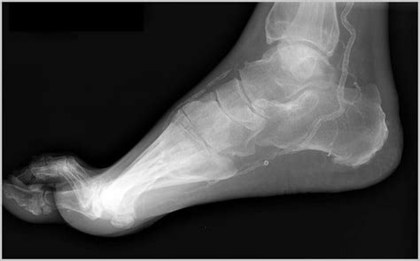 Calcification: Symptoms, Types and Causes - Home Remedy