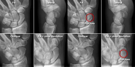 Ulnar Deviation X Ray