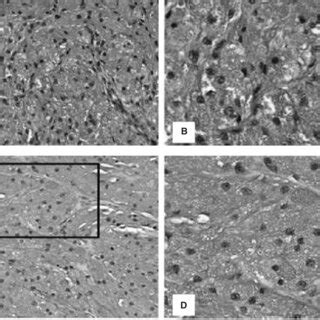 Granular cell tumor histology. The lesion consisted of large ...