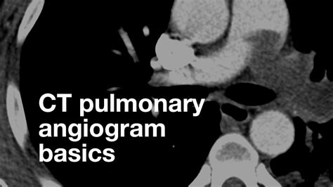 Pulmonary Angiogram Anatomy