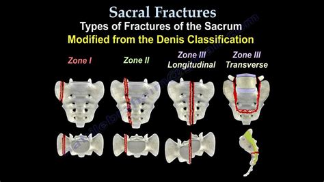 Sacral Fractures - Everything You Need To Know - Dr. Nabil Ebraheim ...