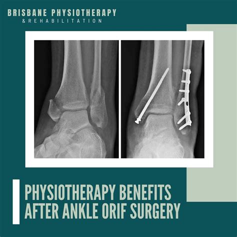 Physiotherapy Benefits after Ankle ORIF Surgery - Brisbane Physiotherapy