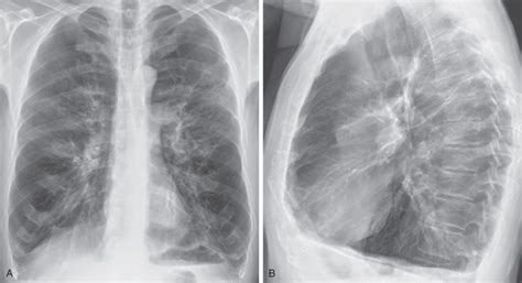 Emphysema | Radiology Key