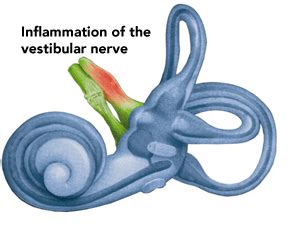 Vestibular Neuritis and Labyrinthitis | Atrium Health Wake Forest Baptist