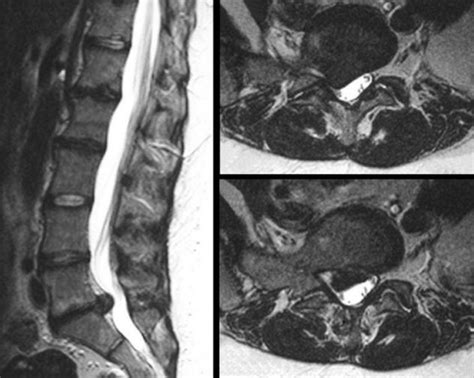 Herniated Disc Mri L5 S1 - Lumbar Herniated Disc - A More in Depth Look - Why does disc bulge or ...