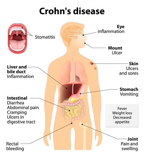 What is Crohn’s Disease - Volleypost