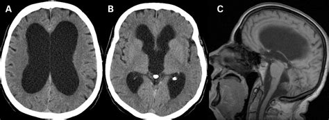 Memory loss with enlarged brain ventricles | BMJ Case Reports