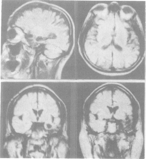 Case 2 MRI: the most affected areas side insula and the left temporal... | Download Scientific ...