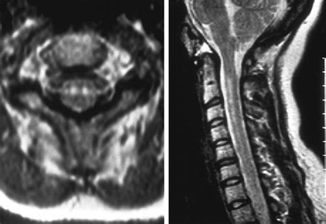 Symmetrical Infarction of the Cervical Spinal Cord Due to Spontaneous ...