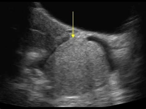 Gynaecology | 3.2 Adnexa : Case 3.2.2 Dermoid cysts / cystic teratomas | Ultrasound Cases