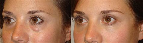 Dark-Circle-Removal-Los-Angeles | Taban MD oculoplastic cosmetic eyelid plastic surgeon Beverly ...