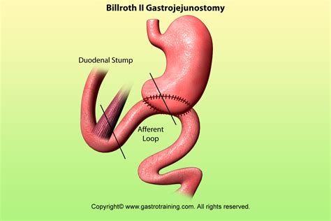 Gastroenterology Education and CPD for trainees and specialists » Surgery for Peptic Ulcer Disease