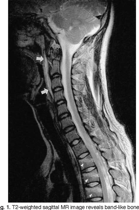 Figure 1 from Non-Contiguous Spinal Injury in Cervical Spinal Trauma: Evaluation with Cervical ...