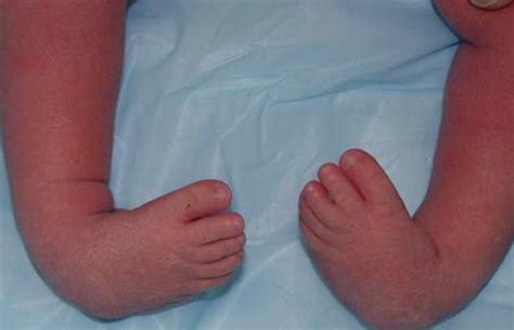 Club Foot - Pictures, Symptoms, Causes, Treatment