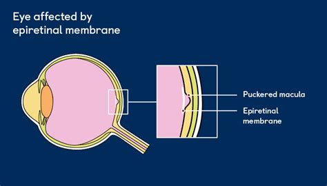 Epiretinal Membrane | Your Eye Health