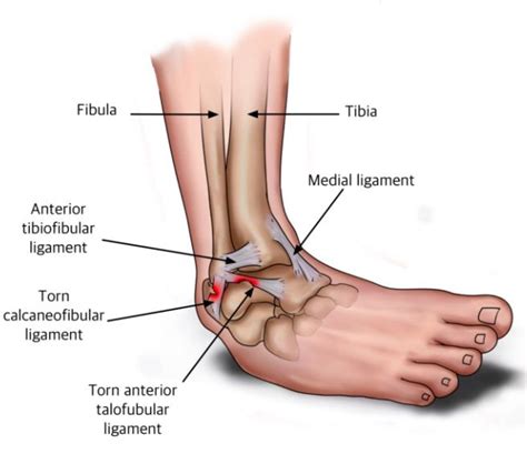 Ankle Sprain | Sprained ankle, Ankle anatomy, Ankle pain