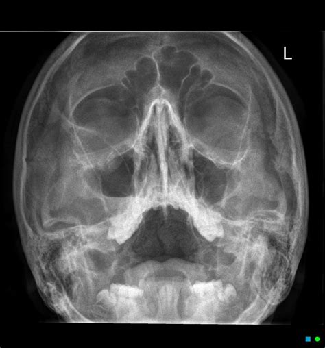 BLOW-OUT FRACTURE | Buyxraysonline