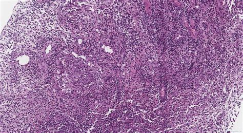 Cystic neutrophilic granulomatous mastitis | Ottawa Atlas of Pathology