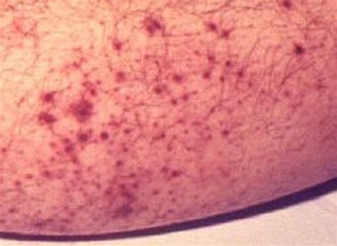 Petechiae - Pictures, Causes, Symptoms, Diagnosis and Treatment