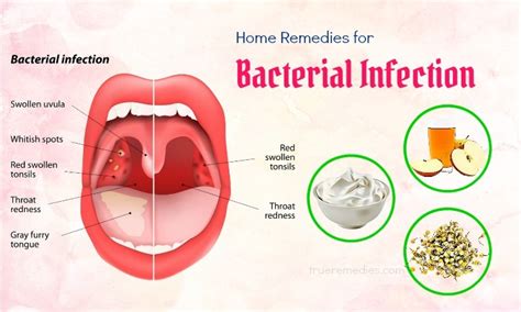 10 Best Home Remedies For Bacterial Infection In Throat & Mouth