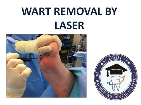 Wart removal by laser