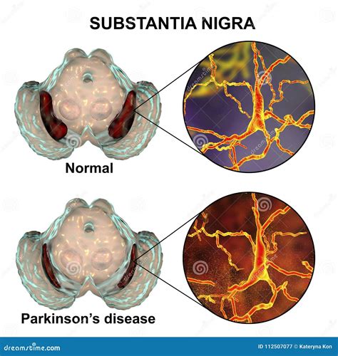 Substantia Nigra in Norm and in Parkinson`s Disease Stock Image - Image of closeup, neurological ...