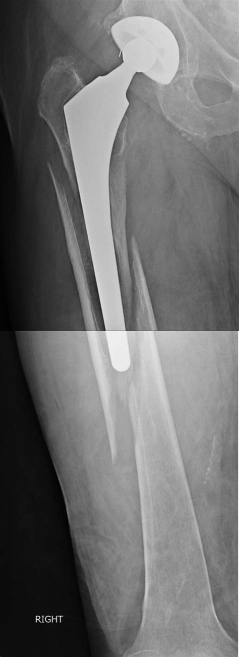 Revision THA for a severe periprosthetic hip fracture – Darwin Chen, MD