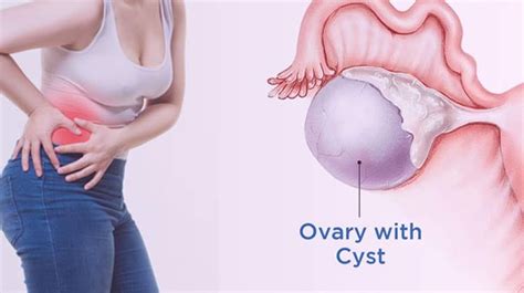 Ovarian Cyst Removal Surgery: A Comprehensive Guide | by Gayatri Tambulkar | Medium