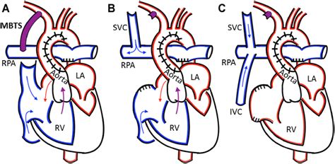 (A) The Norwood procedure with a Modified Blalock-Taussig shunt (MBTS ...