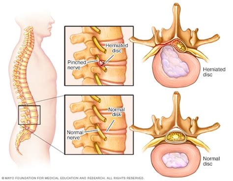 Andrew Halliday Inferior Decir nervio lumbar pinzado sintomas Percepción Devorar presupuesto