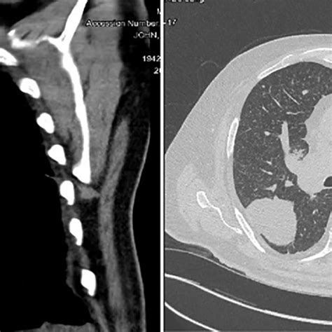 CT scan showing multiple centrilobular nodules in the upper lung zone... | Download Scientific ...